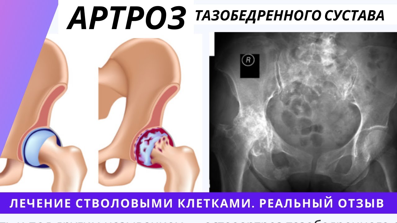 Тазобедренный сустав после операции отзывы пациентов. SVF терапия тазобедренных суставов. Артроз тазобедренного сустава 2 степени.