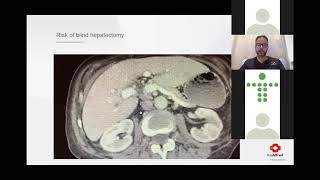 Trauma Grand Rounds Part 2 – Complex Hepatic Injury Trauma Grand Rounds Part 2 – Complex Hepatic Injury