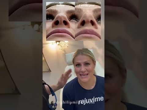Video thumbnail: 3 Weeks Post Rhinoplasty! Amazing Results Revealed! · Dr. Philip Miller, MD, FACS