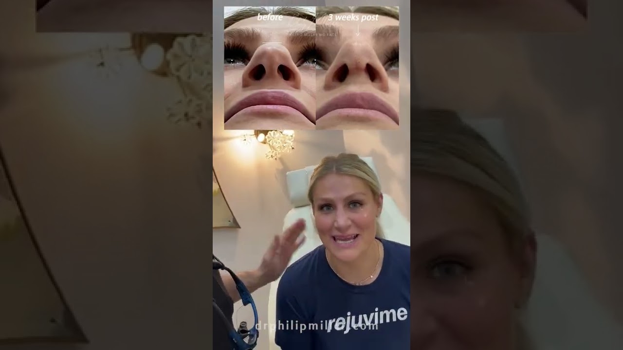 3 Weeks Post Rhinoplasty! Amazing Results Revealed!