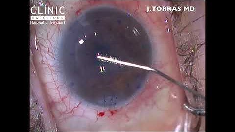 TIPS IN DMEK SURGERY