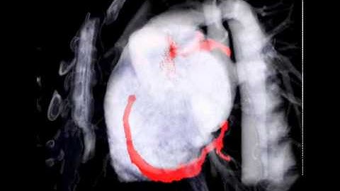 Globally Optimal Active Contours, Sequential Monte Carlo and On-Line Learning for Vessel Segmentati