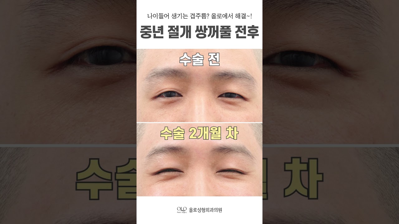 [Олло гоо сайхны мэс заслын эмнэлэг] #дунднасны_нүдний_мэс_засал #давхардсан_үрчлээс-ний талаар санаа зовж байна уу? #богино_бичлэг