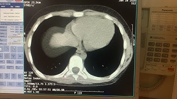 CT Streak Artifact Example