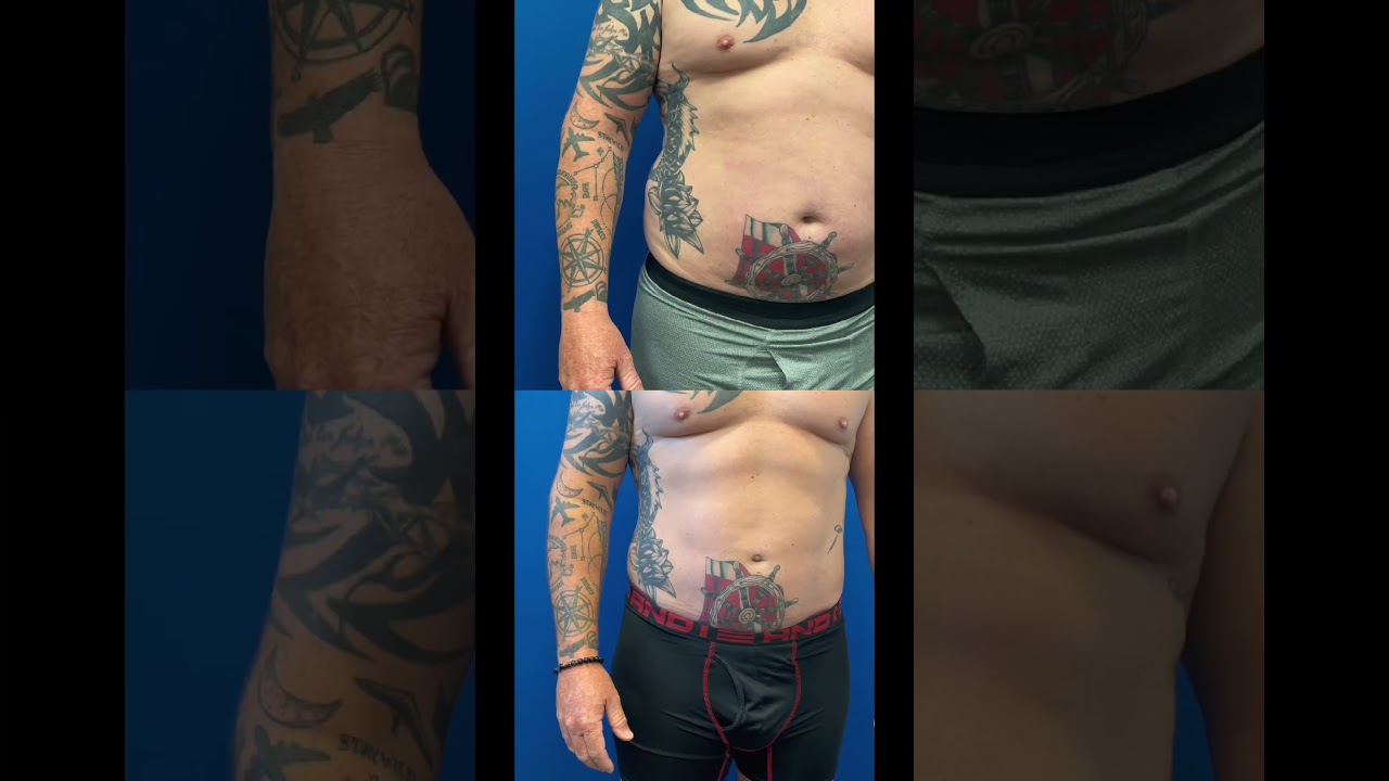 Male 360 Liposuction results after 2 months | Dr. Erick Sanchez | Baton Rouge, LA
