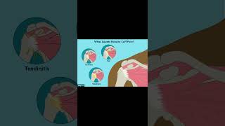 Empty Can Test | Supraspinatus Shoulder Exam Explained #shoulderpain #meded #orthopedic #ATC #physio