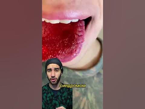 ужасные трещины на языке - YouTube
