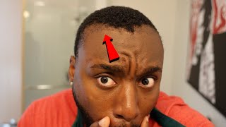 ITS HAPPENING... MY HAIRLINE SURGERY IS WORKING!?