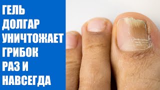 Лечение грибка стопы в домашних условиях ⚠ Препараты для лечения грибка кожи ног