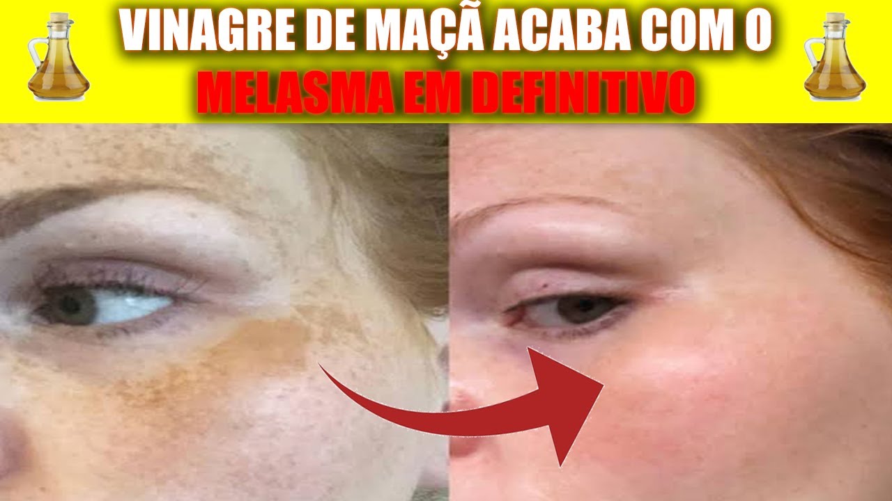 Como Acabar Com Melasma? Use Vinagre de Maça Para Tirar Manchas do ...