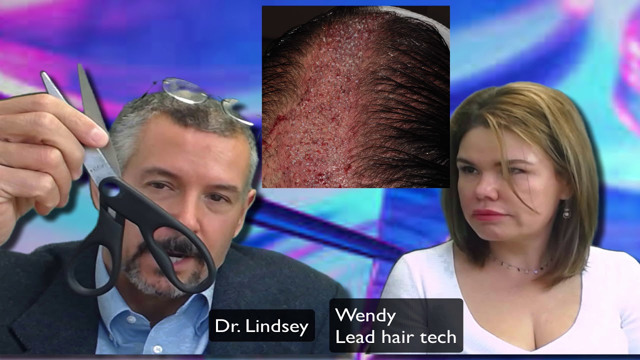 Awesome hair transplant repair in Washington DC by Dr. Lindsey McLean