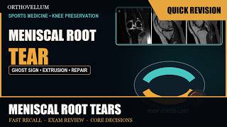 Meniscal Root Tears — The Hoop-Stress Failure — Quick Revision (exam review)