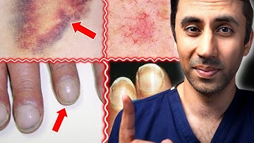 Dokter Menjelaskan 11 Tanda Kulit Penyakit Hati / Hati Berlemak / Sirosis
