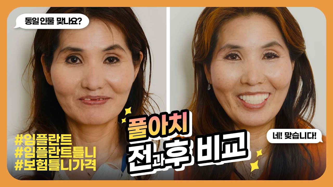 🦷#임플란트틀니? 풀아치 수술 환자가 직접 말하는😁 REAL후기!👀 #전체임플란트 #보험틀니 가격보다 좋을까?