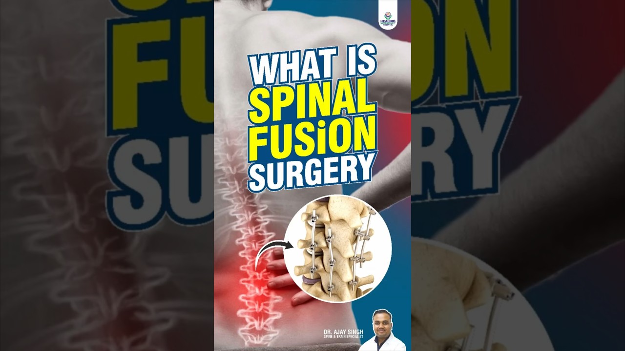 What Is Spinal Fusion Surgery? Procedure, Benefits & Recovery Explained