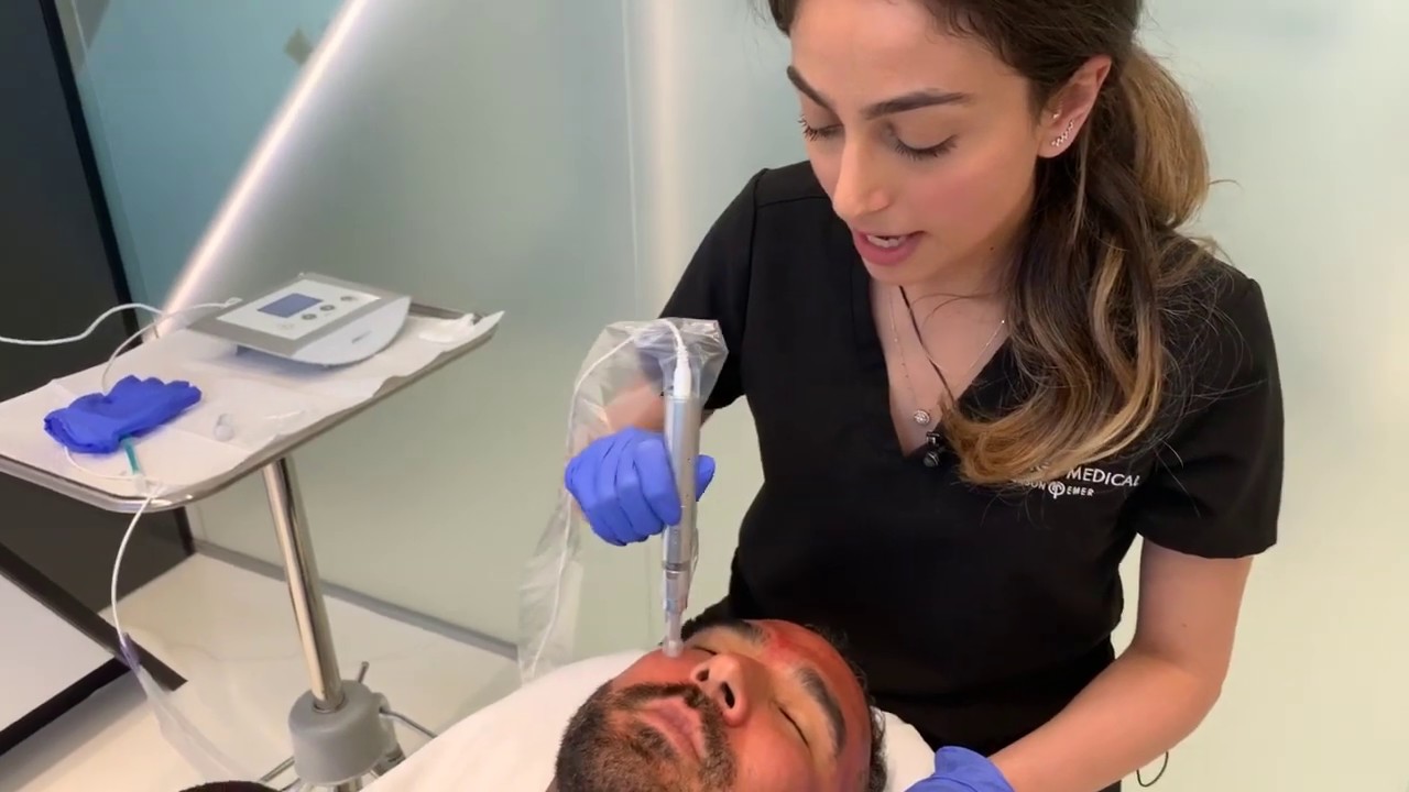 Amiea Microneedling | Facial Rejuvenation & Skin Tightening | West Hollywood, CA | Dr. Jason Emer
