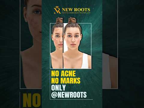 Acne Marks Treatment at New Roots Aurangabad | Get Clear Skin Now! #shorts