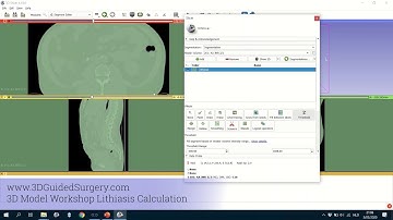Tutorial for renal calculus volume estimation in 3D slicer