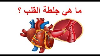 ما هي جلطة القلب ؟  النوبة القلبية - الأزمة القلبية - قصور الشريان التاجي الحاد - أحتشاء عضلة القلب