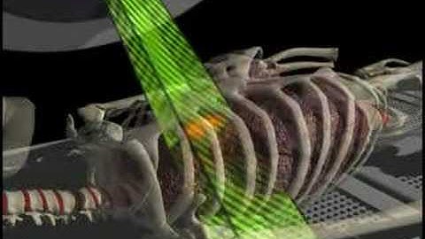 Cancer treatment with respiratory gating