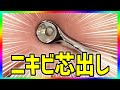 ニキビ芯出し・ニキビ潰す動画　acne treatment in Japan