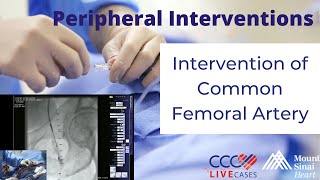 Intervention of Common Femoral Artery - February 27, 2013 Live Case Video