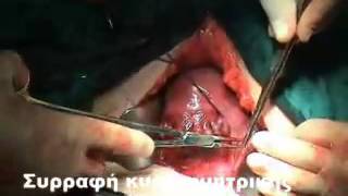 Cesarean Section