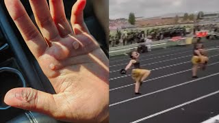 Download Lagu Teens Get Painful Blisters After Punishment By Dance Coach: Parents MP3 Download Lagu Teens Get Painful Blisters After Punishment By Dance Coach: Parents MP3