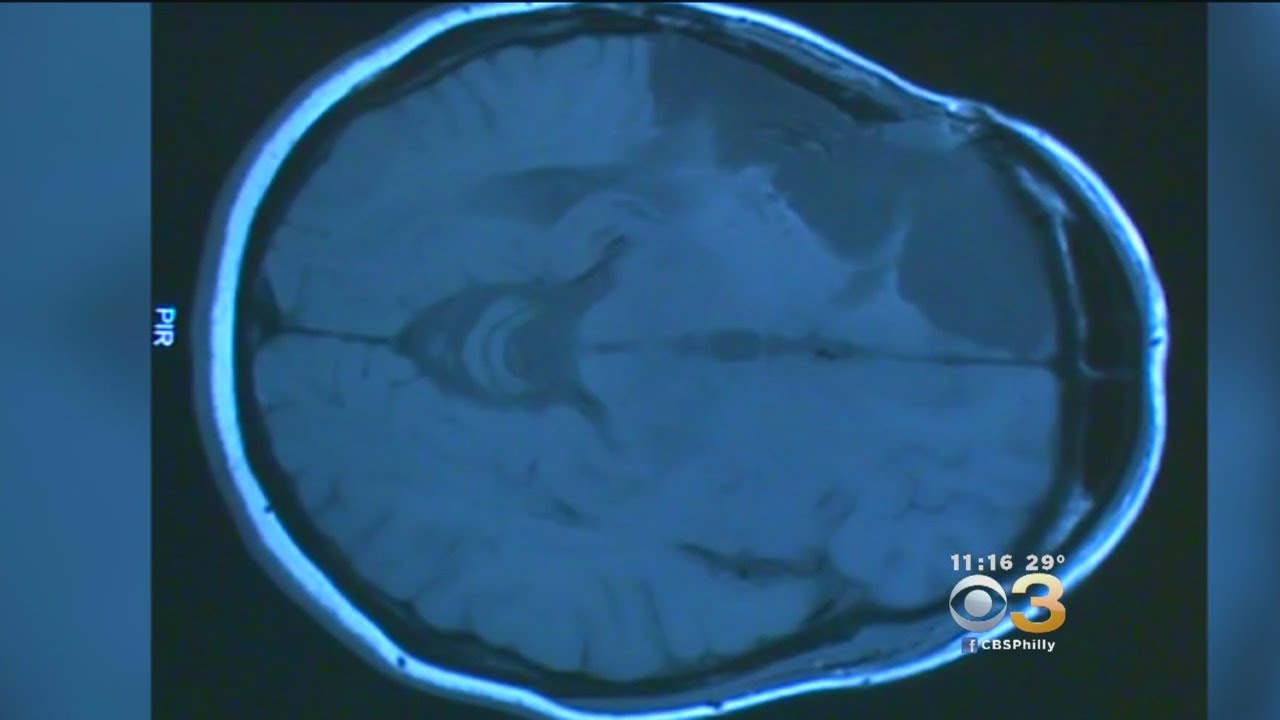 Too Much Stress Can Literally Shrink Your Brain, Experts Say - YouTube