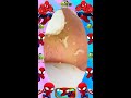 Blackheads Removal | Acne Treatment and Very Satisfying Satisfying Pimple pop #blackheads