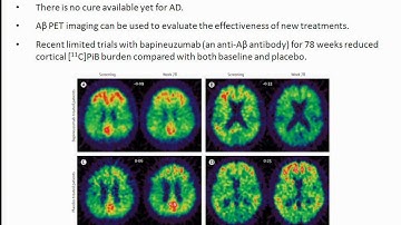 Brain Imaging and Neurodegenerative Disorders