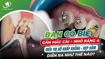 Kĩ thuật chỉnh nha | GẮN MẮC CÀI NIỀNG RĂNG - Cứu tinh cho răng khấp khểnh, lệch khỏi cung răng