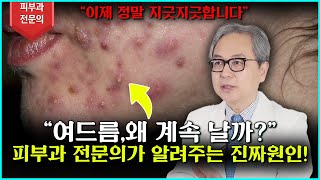 [여드름]📌 여드름이 나는 진짜 이유! 당신도 몰랐던 피부 속 비밀 🧐