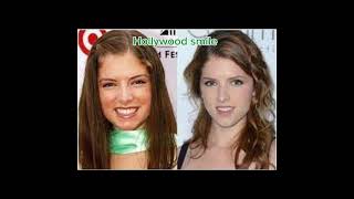 Anna Kendrick Plastic Surgery Information