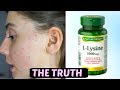 I TOOK LYSINE FOR 2 WEEKS STRAIGHT|| THIS IS WHAT HAPPENED TO ACNE SCARS