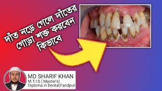 নড়া দাঁত কিভাবে শক্ত করব ||  দাঁত কেন নড়ে যায় Noor dental BD screenshot 5