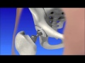 Hip arthroplasty  hip replacement