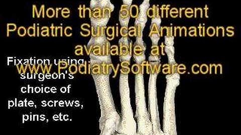 Lapidus Bunionectomy - Surgical Animation