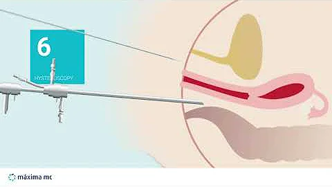 Endometrial ablation under local anesthesia - Mxim...