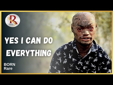 An Indian Man is Called Snake Man because of a Rare Skin Diseases