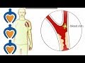 Thrombosis - What is it and how is it treated?