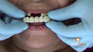 cara membersihkan lem gigi palsu yang menempel pada gigi palsu