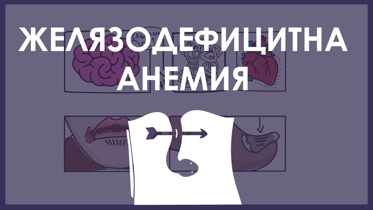 Хематология | Желязонеодимъчна анемия. Етиология, патофизиология, клинична картина, ДД и лечение.