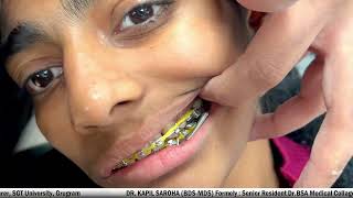 Forsus Appliance in Orthodontics || Dr. Kapil Saroha BDS, MDS