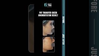 Fat Transfer Cheek Augmentation Result |गालों की प्राकृतिक सुंदरता का वास्तविक परिवर्तन Dr.Pk Talwar
