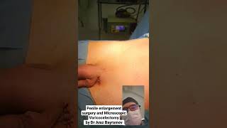 Penile enlargement surgery and Microscopic Varicocelectomy by Dr Araz Bayramov #andrologist #penis