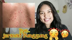 ATASI JERAWAT PUNGGUNG KALIAN GUYS ð|| DESY CAHYANI LARI - Durasi: 9.11. ATASI JERAWAT PUNGGUNG KALIAN GUYS ð|| DESY CAHYANI LARI - Durasi: 9.11.