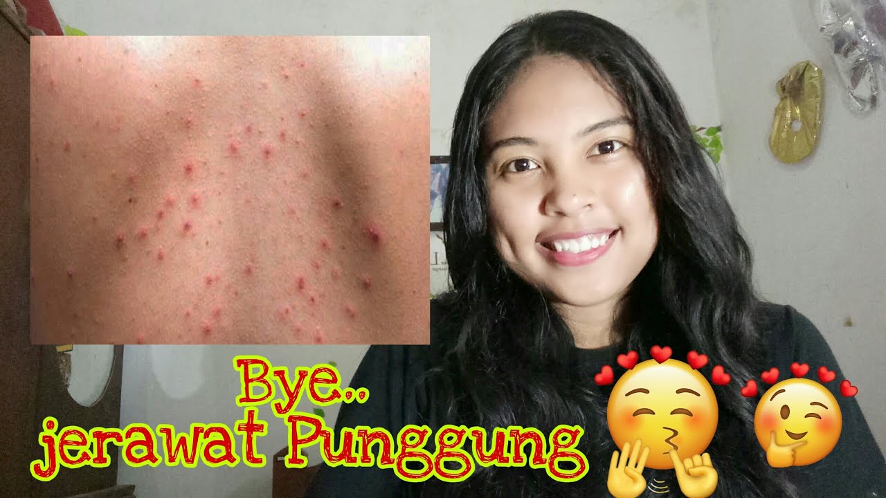 ATASI JERAWAT PUNGGUNG KALIAN GUYS 😀|| DESY CAHYANI LARI 