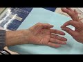 看護師と患者さんとの会話（手根管症候群手術例）【スタッフ作成動画】