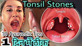 Tonsil Stone | 10 आयुर्वेदिक उपचार | सिर्फ 1 दिन में टॉन्सिल ठीक हो जाएगी बिना सर्जरी  के | 